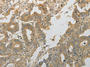 The image on the left is immunohistochemistry of paraffin-embedded Human gastric cancer tissue using CSB-PA205557(PLAU Antibody) at dilution 1/10, on the right is treated with fusion protein. (Original magnification: ×200)
