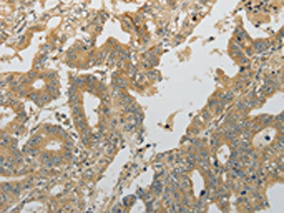 The image on the left is immunohistochemistry of paraffin-embedded Human gastric cancer tissue using CSB-PA205557(PLAU Antibody) at dilution 1/10, on the right is treated with fusion protein. (Original magnification: ×200)