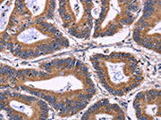 The image on the left is immunohistochemistry of paraffin-embedded Human colon cancer tissue using CSB-PA205578(KIR2DL3/KIR2DL1/KIR2DL4/KIR2DS4 Antibody) at dilution 1/40, on the right is treated with fusion protein. (Original magnification: ×200)