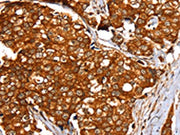 The image on the left is immunohistochemistry of paraffin-embedded Human breast cancer tissue using CSB-PA205708(SLC24A3 Antibody) at dilution 1/20, on the right is treated with synthetic peptide. (Original magnification: ×200)