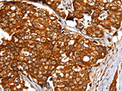 The image on the left is immunohistochemistry of paraffin-embedded Human breast cancer tissue using CSB-PA205708(SLC24A3 Antibody) at dilution 1/20, on the right is treated with synthetic peptide. (Original magnification: ×200)