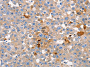 The image on the left is immunohistochemistry of paraffin-embedded Human breast cancer tissue using CSB-PA205738(GJB6 Antibody) at dilution 1/15, on the right is treated with synthetic peptide. (Original magnification: ×200)