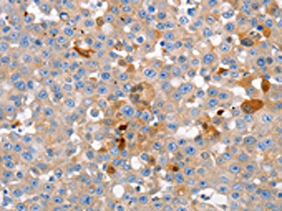 The image on the left is immunohistochemistry of paraffin-embedded Human breast cancer tissue using CSB-PA205738(GJB6 Antibody) at dilution 1/15, on the right is treated with synthetic peptide. (Original magnification: ×200)