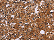The image on the left is immunohistochemistry of paraffin-embedded Human thyroid cancer tissue using CSB-PA205879(EGR4 Antibody) at dilution 1/20, on the right is treated with synthetic peptide. (Original magnification: ×200)