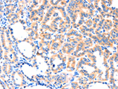 The image on the left is immunohistochemistry of paraffin-embedded Human thyroid cancer tissue using CSB-PA206082(THBS1 Antibody) at dilution 1/50, on the right is treated with synthetic peptide. (Original magnification: ×200)