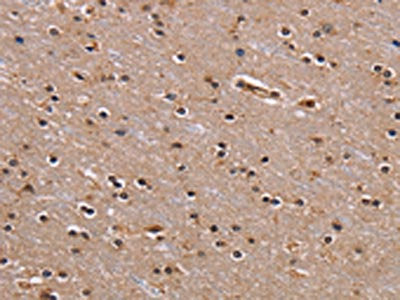 The image on the left is immunohistochemistry of paraffin-embedded Human brain tissue using CSB-PA206311(GNL3 Antibody) at dilution 1/60, on the right is treated with fusion protein. (Original magnification: ×200)