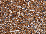 The image on the left is immunohistochemistry of paraffin-embedded Human prostate cancer tissue using CSB-PA206609(LRRC15 Antibody) at dilution 1/60, on the right is treated with fusion protein. (Original magnification: ×200)