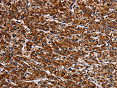 The image on the left is immunohistochemistry of paraffin-embedded Human prostate cancer tissue using CSB-PA206609(LRRC15 Antibody) at dilution 1/60, on the right is treated with fusion protein. (Original magnification: ×200)