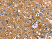 The image on the left is immunohistochemistry of paraffin-embedded Human liver cancer tissue using CSB-PA206663(SAMD4A Antibody) at dilution 1/35, on the right is treated with synthetic peptide. (Original magnification: ×200)