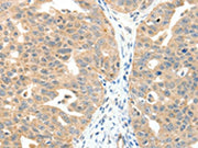 The image on the left is immunohistochemistry of paraffin-embedded Human ovarian cancer tissue using CSB-PA206897(MAP3K14 Antibody) at dilution 1/20, on the right is treated with fusion protein. (Original magnification: ×200)