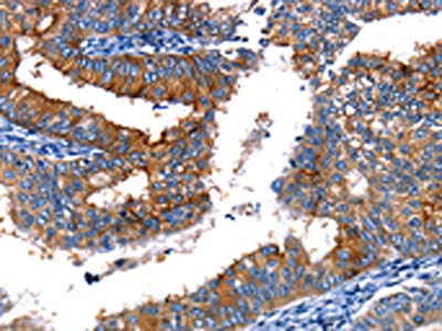The image on the left is immunohistochemistry of paraffin-embedded Human cervical cancer tissue using CSB-PA207146(TBX22 Antibody) at dilution 1/15, on the right is treated with fusion protein. (Original magnification: ×200)