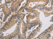 The image on the left is immunohistochemistry of paraffin-embedded Human colon cancer tissue using CSB-PA207190(ITIH1 Antibody) at dilution 1/30, on the right is treated with synthetic peptide. (Original magnification: x200)