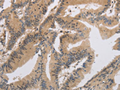 The image on the left is immunohistochemistry of paraffin-embedded Human colon cancer tissue using CSB-PA207190(ITIH1 Antibody) at dilution 1/30, on the right is treated with synthetic peptide. (Original magnification: x200)