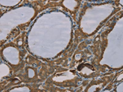 The image on the left is immunohistochemistry of paraffin-embedded Human thyroid cancer tissue using CSB-PA207315(S100A6 Antibody) at dilution 1/35, on the right is treated with synthetic peptide. (Original magnification: ×200)