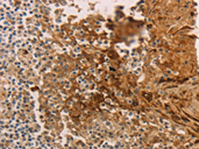 The image on the left is immunohistochemistry of paraffin-embedded Human tonsil tissue using CSB-PA207627(ADCYAP1R1 Antibody) at dilution 1/70, on the right is treated with synthetic peptide. (Original magnification: ×200)