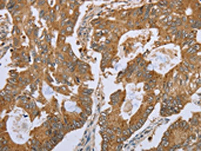 The image on the left is immunohistochemistry of paraffin-embedded Human colon cancer tissue using CSB-PA207849(NLRP10 Antibody) at dilution 1/45, on the right is treated with synthetic peptide. (Original magnification: ×200)