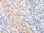 The image on the left is immunohistochemistry of paraffin-embedded Human lung cancer tissue using CSB-PA207869(MUC2 Antibody) at dilution 1/60, on the right is treated with synthetic peptide. (Original magnification: ×200)