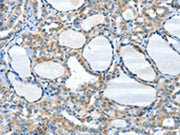 The image on the left is immunohistochemistry of paraffin-embedded Human thyroid cancer tissue using CSB-PA207924(HID1 Antibody) at dilution 1/50, on the right is treated with synthetic peptide. (Original magnification: ×200)