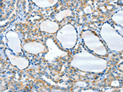 The image on the left is immunohistochemistry of paraffin-embedded Human thyroid cancer tissue using CSB-PA207924(HID1 Antibody) at dilution 1/50, on the right is treated with synthetic peptide. (Original magnification: ×200)