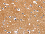 The image on the left is immunohistochemistry of paraffin-embedded Human brain tissue using CSB-PA207957(DUSP10 Antibody) at dilution 1/20, on the right is treated with fusion protein. (Original magnification: ×200)