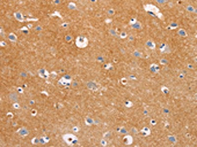 The image on the left is immunohistochemistry of paraffin-embedded Human brain tissue using CSB-PA207957(DUSP10 Antibody) at dilution 1/20, on the right is treated with fusion protein. (Original magnification: ×200)