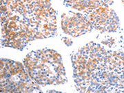 The image on the left is immunohistochemistry of paraffin-embedded Human liver cancer tissue using CSB-PA208167(SLC44A1 Antibody) at dilution 1/25, on the right is treated with synthetic peptide. (Original magnification: ×200)