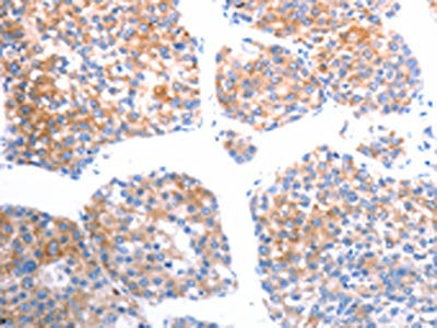 The image on the left is immunohistochemistry of paraffin-embedded Human liver cancer tissue using CSB-PA208167(SLC44A1 Antibody) at dilution 1/25, on the right is treated with synthetic peptide. (Original magnification: ×200)