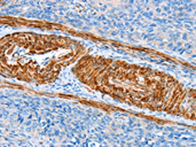 The image on the left is immunohistochemistry of paraffin-embedded Human cervical cancer tissue using CSB-PA208319(AARS Antibody) at dilution 1/60, on the right is treated with synthetic peptide. (Original magnification: ×200)