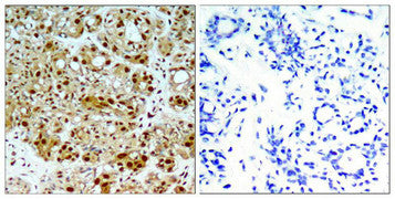 Immunohistochemical analysis of paraffin-embedded human breast carcinoma tissue using HSP90B(Ab-254) Antibody(left) or the same antibody preincubated with blocking peptide(right).