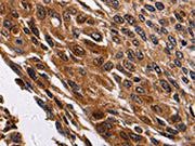The image is immunohistochemistry of paraffin-embedded Human cervical cancer tissue using CSB-PA208593(RAB41 Antibody) at dilution 1/100. (Original magnification: ×200)