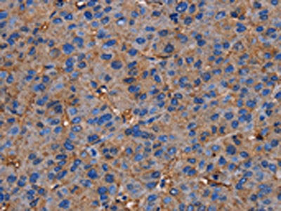 The image on the left is immunohistochemistry of paraffin-embedded Human liver cancer tissue using CSB-PA208655(NRIP3 Antibody) at dilution 1/60, on the right is treated with fusion protein. (Original magnification: ×200)
