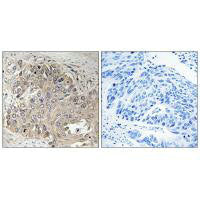 Immunohistochemistry analysis of paraffin-embedded human lung carcinoma tissue using SPTBN5 antibody.