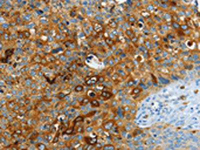 The image on the left is immunohistochemistry of paraffin-embedded Human cervical cancer tissue using CSB-PA208943(ASAH1 Antibody) at dilution 1/40, on the right is treated with fusion protein. (Original magnification: ×200)