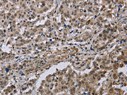 The image on the left is immunohistochemistry of paraffin-embedded Human liver cancer tissue using CSB-PA208982(MGLL Antibody) at dilution 1/40, on the right is treated with synthetic peptide. (Original magnification: ×200)