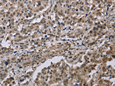 The image on the left is immunohistochemistry of paraffin-embedded Human liver cancer tissue using CSB-PA208982(MGLL Antibody) at dilution 1/40, on the right is treated with synthetic peptide. (Original magnification: ×200)