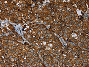 The image on the left is immunohistochemistry of paraffin-embedded Human breast cancer tissue using CSB-PA209003(ERBB4 Antibody) at dilution 1/40, on the right is treated with fusion protein. (Original magnification: ×200)