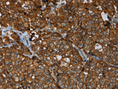 The image on the left is immunohistochemistry of paraffin-embedded Human breast cancer tissue using CSB-PA209003(ERBB4 Antibody) at dilution 1/40, on the right is treated with fusion protein. (Original magnification: ×200)