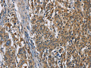 The image is immunohistochemistry of paraffin-embedded Human gastic cancer tissue using CSB-PA209031(SIGMAR1 Antibody) at dilution 1/50. (Original magnification: ×200)