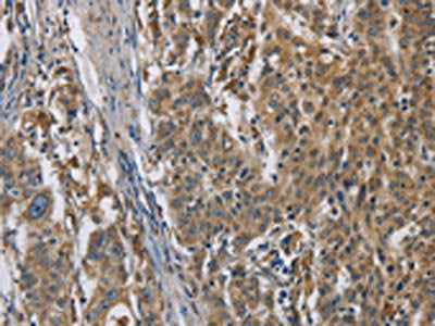 The image is immunohistochemistry of paraffin-embedded Human gastic cancer tissue using CSB-PA209031(SIGMAR1 Antibody) at dilution 1/50. (Original magnification: ×200)