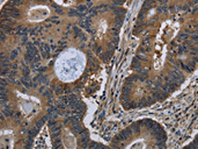 The image on the left is immunohistochemistry of paraffin-embedded Human colon cancer tissue using CSB-PA209085(TSC22D3 Antibody) at dilution 1/40, on the right is treated with fusion protein. (Original magnification: ×200)