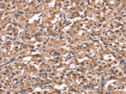 The image on the left is immunohistochemistry of paraffin-embedded Human thyroid cancer tissue using CSB-PA209267(HRH1 Antibody) at dilution 1/40, on the right is treated with synthetic peptide. (Original magnification: ×200)