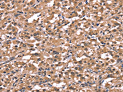 The image on the left is immunohistochemistry of paraffin-embedded Human thyroid cancer tissue using CSB-PA209267(HRH1 Antibody) at dilution 1/40, on the right is treated with synthetic peptide. (Original magnification: ×200)