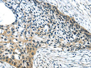 The image on the left is immunohistochemistry of paraffin-embedded Human esophagus cancer tissue using CSB-PA209337(HCN4 Antibody) at dilution 1/35, on the right is treated with synthetic peptide. (Original magnification: ×200)