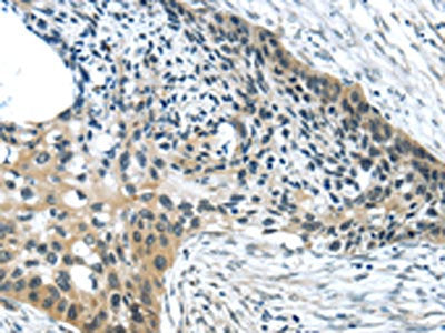 The image on the left is immunohistochemistry of paraffin-embedded Human esophagus cancer tissue using CSB-PA209337(HCN4 Antibody) at dilution 1/35, on the right is treated with synthetic peptide. (Original magnification: ×200)