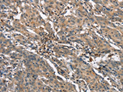 The image is immunohistochemistry of paraffin-embedded Human gastic cancer tissue using CSB-PA209407(NLRP3 Antibody) at dilution 1/25. (Original magnification: ×200)