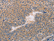 The image on the left is immunohistochemistry of paraffin-embedded Human liver cancer tissue using CSB-PA209503(CASP10 Antibody) at dilution 1/30, on the right is treated with fusion protein. (Original magnification: ×200)