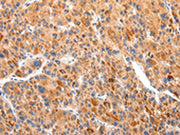 The image on the left is immunohistochemistry of paraffin-embedded Human liver cancer tissue using CSB-PA209578(BSN Antibody) at dilution 1/20, on the right is treated with synthetic peptide. (Original magnification: ×200)