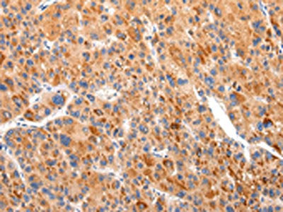 The image on the left is immunohistochemistry of paraffin-embedded Human liver cancer tissue using CSB-PA209578(BSN Antibody) at dilution 1/20, on the right is treated with synthetic peptide. (Original magnification: ×200)