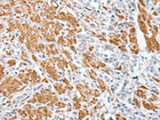 The image on the left is immunohistochemistry of paraffin-embedded Human prostate cancer tissue using CSB-PA209620(CENPC Antibody) at dilution 1/70, on the right is treated with fusion protein. (Original magnification: ×200)