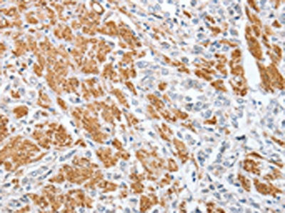 The image on the left is immunohistochemistry of paraffin-embedded Human prostate cancer tissue using CSB-PA209620(CENPC Antibody) at dilution 1/70, on the right is treated with fusion protein. (Original magnification: ×200)